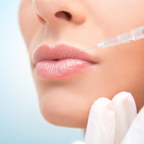 Lip augmentation. Lip augmentation.