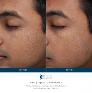 skinpen-male-before-after-1