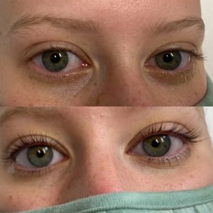 before and after of treatment